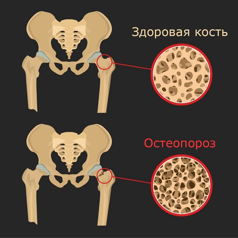 остеопороз и метадон